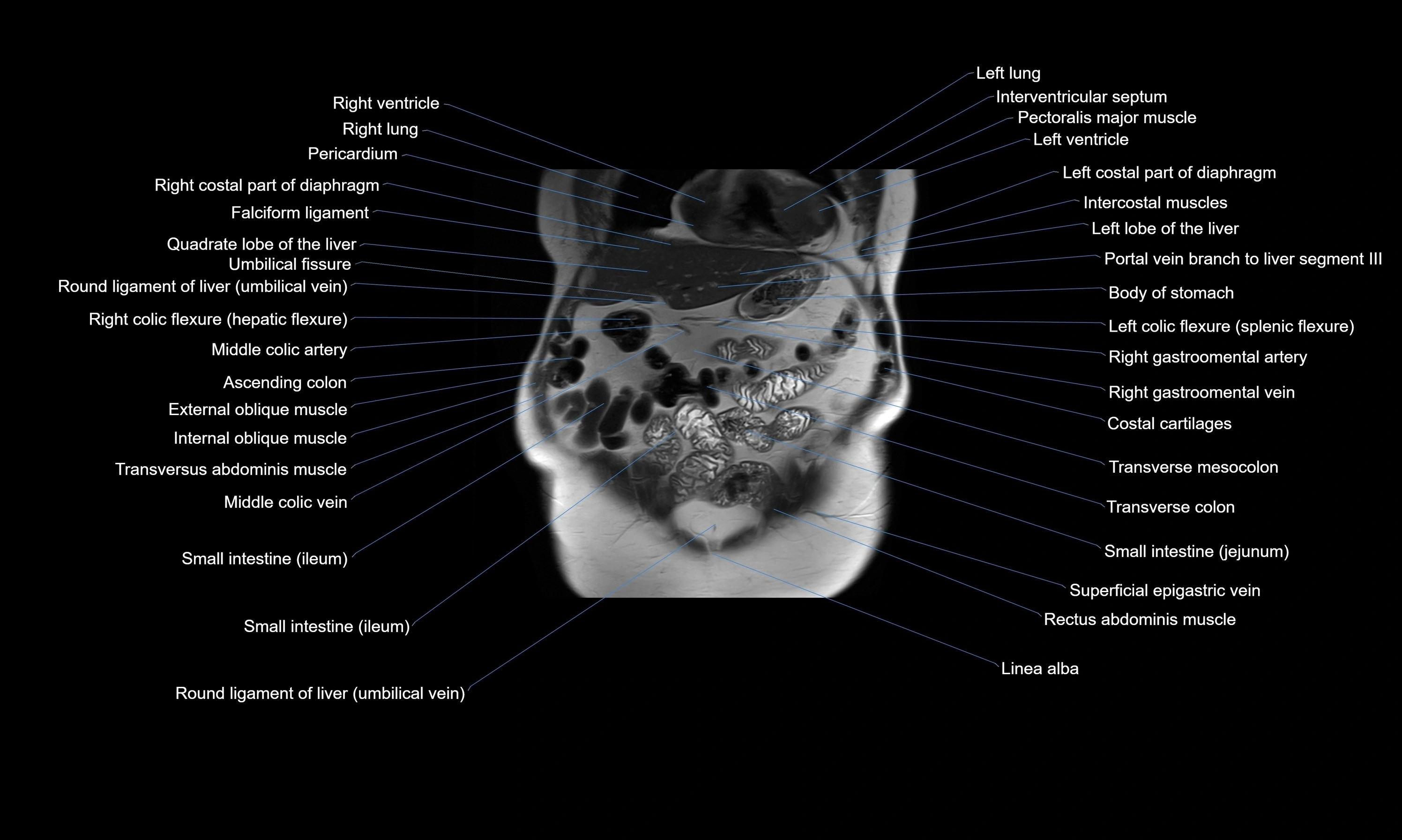 MRI Abdomen axial cross sectional anatomy radiology  image-img-00001-00014.webp